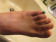 Some marker, some bruising, some blood, and one toe with a stupid pin in it. Two-to-four weeks left, and I should be as good as new. I can't wait to get this thing out of me.